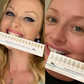 WOW Whites ultimate teeth whitening kit
