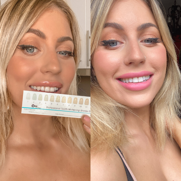 WOW Whites ultimate teeth whitening kit